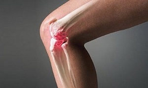 nola desberdintzen den artritisa artrositik
