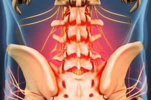 osteokondrosiaren arrazoiak eta sintomak
