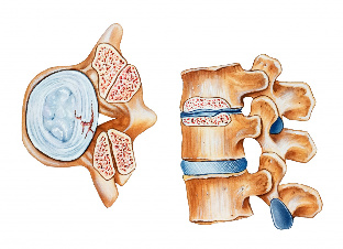 Osteokondrosia