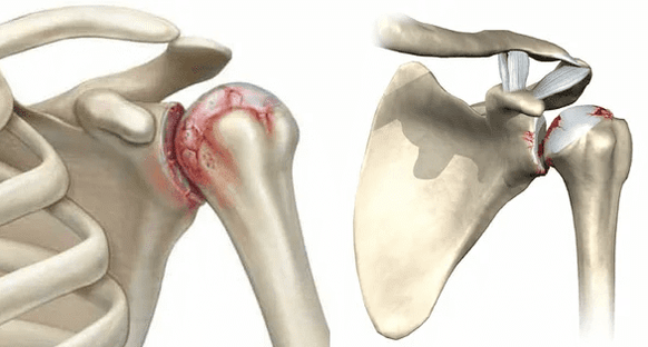 nolakoa da sorbaldako artikulazioaren artrosia