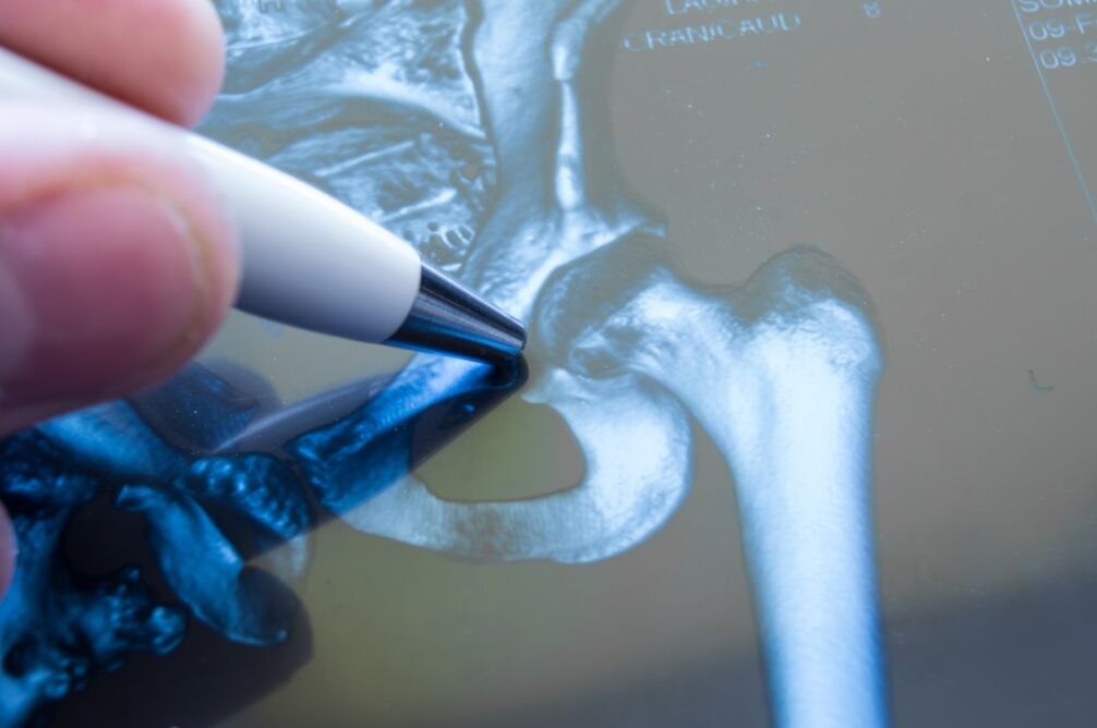 Aldakako artikulazioaren artrosi erradiografian