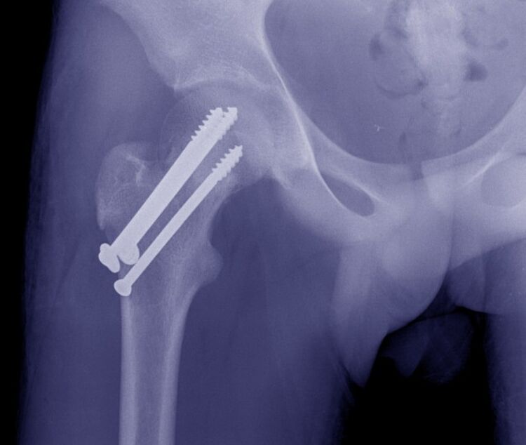 Aldakako artikulazioaren erradiografia, hausturaren osteosintesia barne finkapen gailuekin
