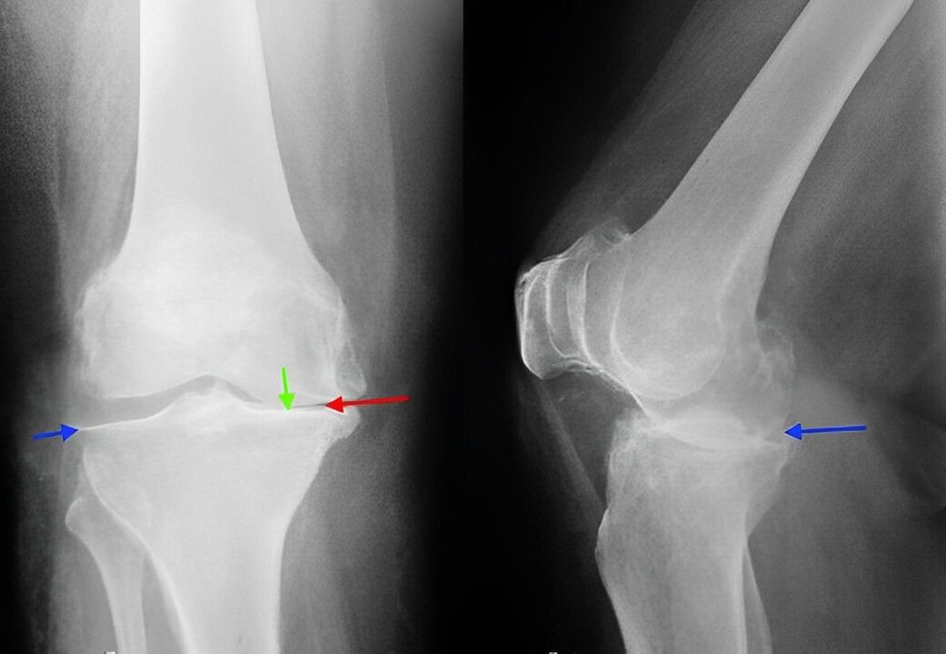 belauneko artikulazioko artrosiaren erradiografia