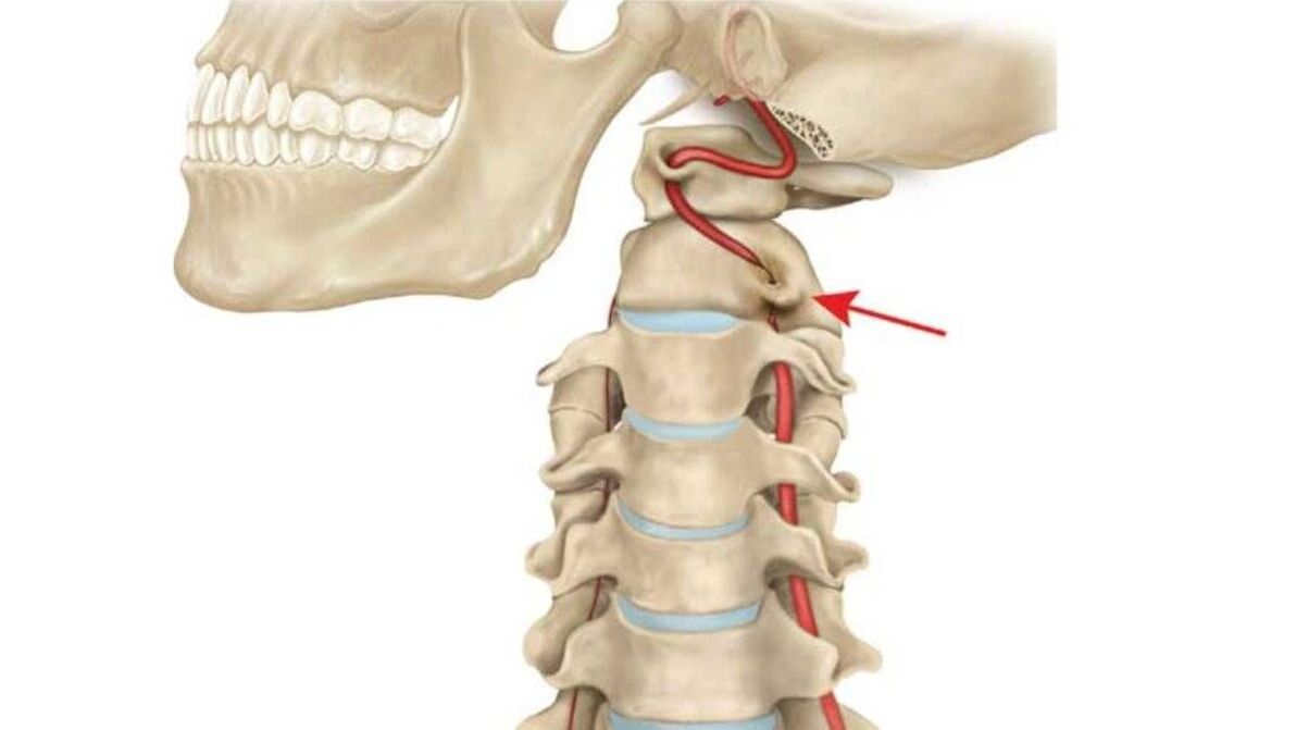 Trápaga bizkarrezurraren osteokondrosia